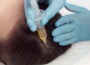 prp hair restoration edmonton